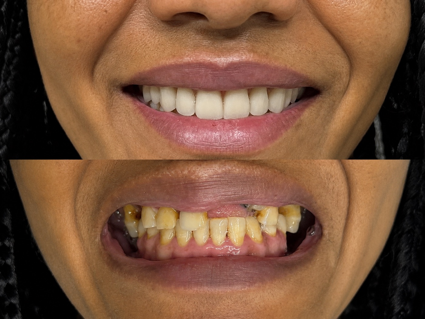 Antes e depois de reabilitação com implantes